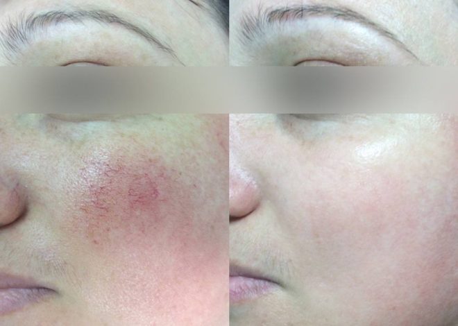 Судинна сітка на обличчі: чому з’являється і як її можна прибрати