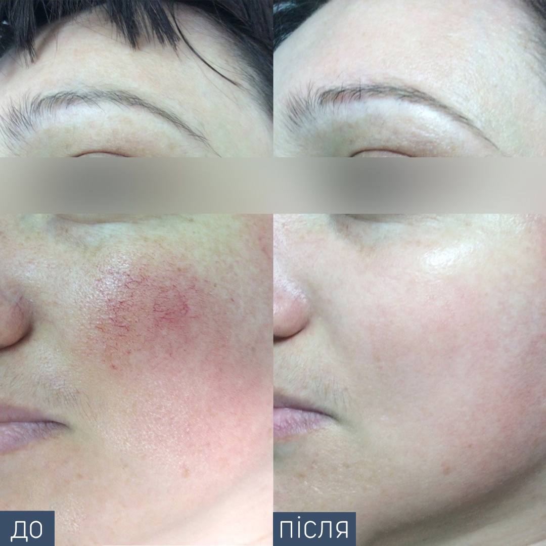 Судинна сітка на обличчі: чому з’являється і як її можна прибрати